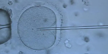 卵母细胞胞浆内单精子显微注射（ICSI）